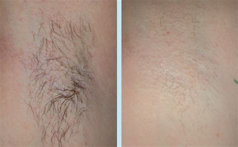 While sugaring this area can still be done during your monthly cycle your can you make sugar wax in the microwave. Hair Removal Today: Waxing As A Hair Removal Method - part 2