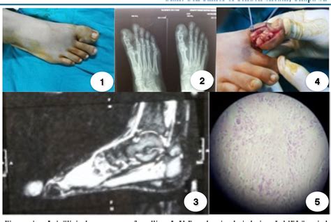 Figure 1 From Giant Cell Tumor Of Tendon Sheath Of Great Toe Semantic