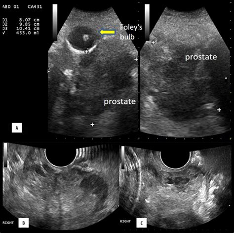 Ultrasonography And Trus In A 85 Year Male With Giant Prostatomegaly