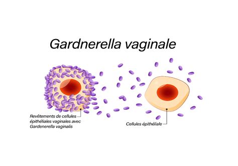 Infection à La Gardnerella Vaginalis Causes Et Traitements