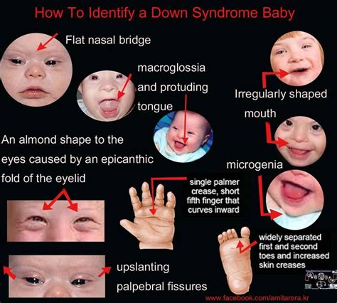 How To Identify A Down Syndrome Baby Pediatric Nursing Pediatric