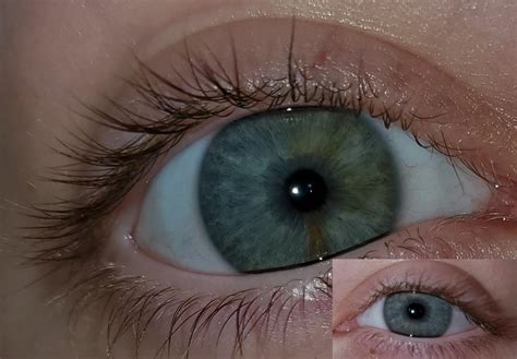 Do I Have Sectoral Heterochromia My Eyes Are Light Gray But One Of