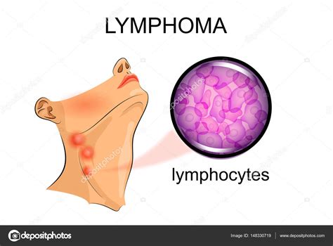 Swollen Lymph Nodes In Lymphoma Oncology Stock Vector Image By