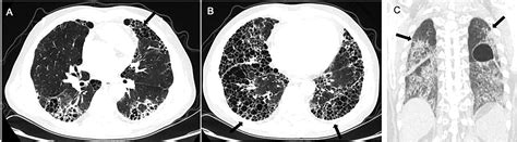 Frontiers Interstitial Lung Disease In Connective Tissue Disease A