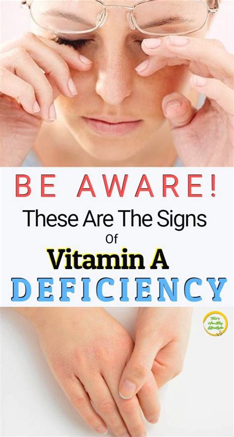 Read What Are The Signs And Symptoms Of Vitamin A Deficiency Why This