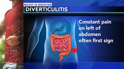 Diverticulitis Symptoms And Treatment For The Surprisingly Common