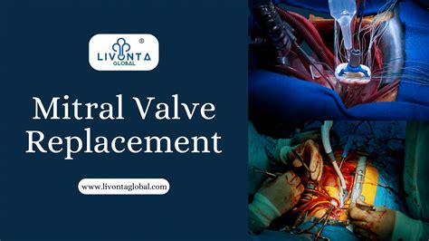 Mitral Valve Replacement Livonta Global Pvt Ltd