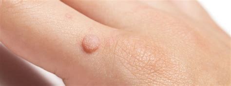 4 Common Warts And How Theyre Treated Dermatology Treatment And