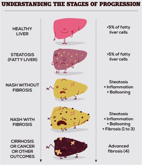 Everything That You Need To Know About The Fatty Liver Disease Grazia
