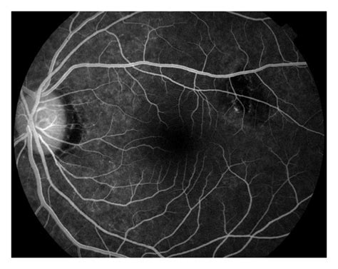 Fluorescein Angiography Left Eye Download Scientific Diagram