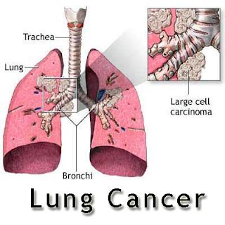 This may cause headaches or even seizures. All About Cancer: Signs Of Lung Cancer