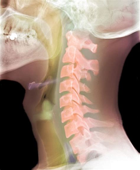 Normal Neck X Ray Photograph By Du Cane Medical Imaging Ltd