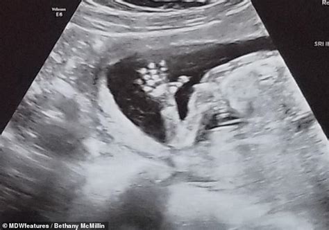 Woman Discovers She Has Two Vaginas And Two Wombs At Scan After Miscarriage Daily Mail Online