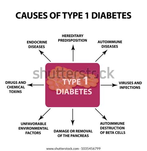Causes Diabetes Type 1 Infographics Vector Stock Vector Royalty Free