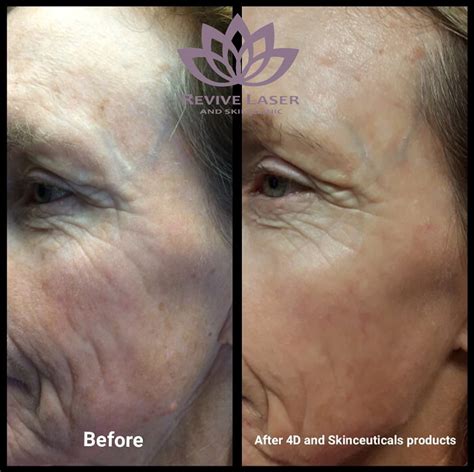 Before And After 4d Laser Treatment Revive Laser And Skin Clinic