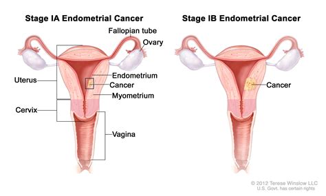 Stage 1 means a small tumor spread to nearby tissue. Endometrial Cancer | Vanderbilt-Ingram Cancer Center