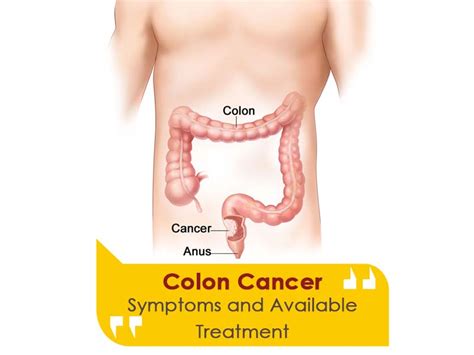 Colorectal Colon Cancer Treatment Symptoms Causes Proctocure