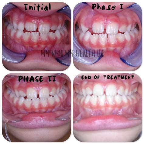 Before And After Tongue Thrust Treatment Myofunctional Therapy
