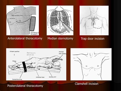 Ppt Surgery In Cardiothoracic Powerpoint Presentation Free Download Id2231294
