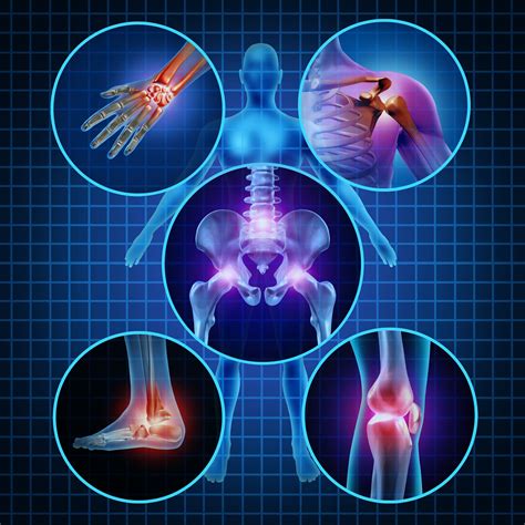 Osteoarthritis Restore Function Physiotherapy