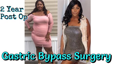 2 Years Post Op Gastric Bypass Regain Sex Life Social Status And More Youtube
