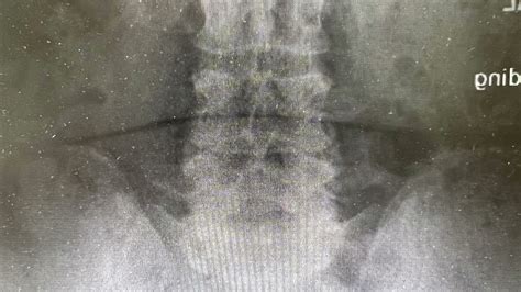Resection Of A Lumbar L4l5 Synovial Cyst Youtube