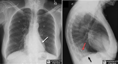Learning Radiology Atelectasis Left Lower Lobe Lll