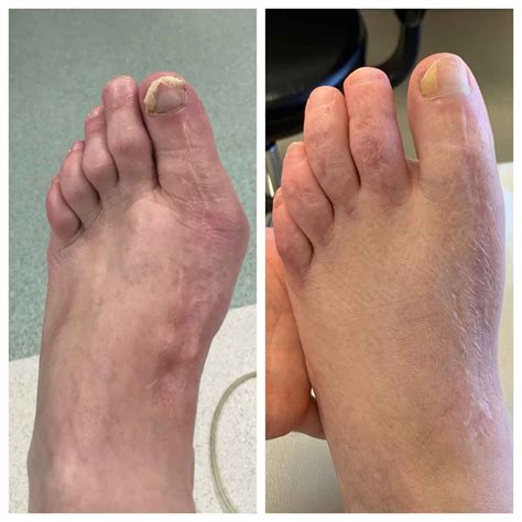 47 Year Female Bunion Correction And Hammertoe Fix Adams Foot And Ankle