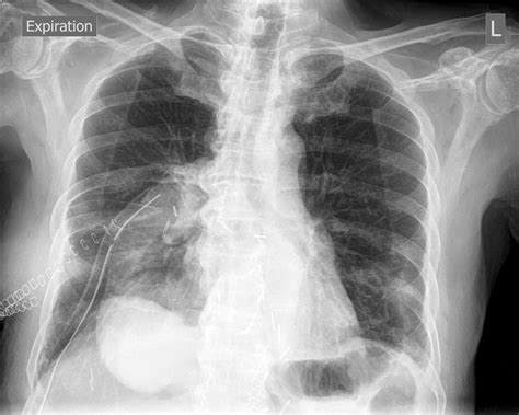 Chest X Ray Showing Right Sided Chest Tube Placement