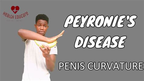 Curvature Of The Penis Peyronie S Disease Youtube