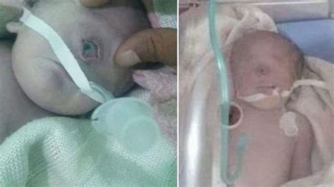 Viral Ada Bayi Bermata Satu Di Yaman Tapi Mendadak Begini Usai 7 Jam