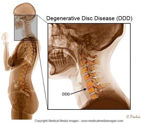 Color X Ray Of The Cervical Spine Showing Degenerative Disc Disease