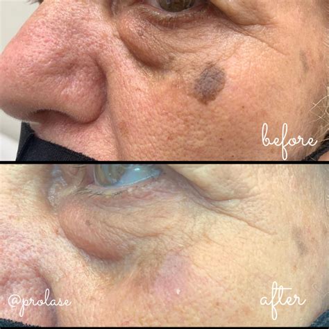 Sun Spots And Age Spots Removal Prolase Laser Clinic