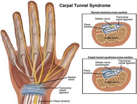 Carpal Tunnel Syndrome Prevention And Treatment