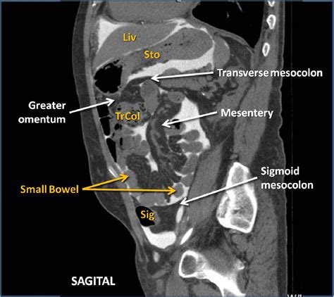 Peritoneal Cavity Anatomy In Ct Peritoneography A Comprehensive My