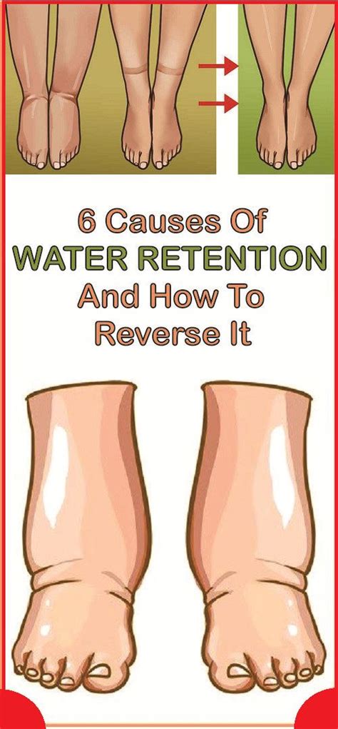 6 Causes Of Water Retention And How To Reverse It Wellness Days