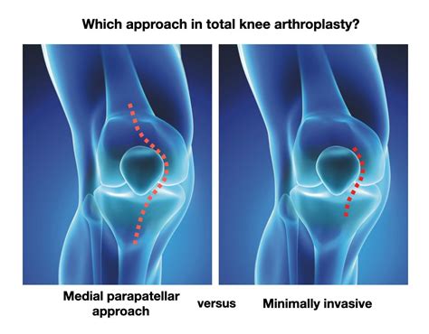Knee Surgery Sports Traumatology Arthroscopy On Twitter This Meta