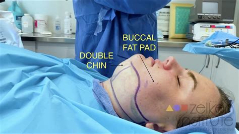Wow Facial Contouring Surgery Buccal Fat Pad Removal And Submental