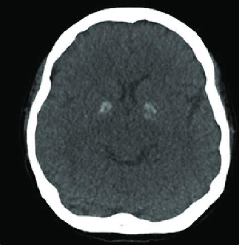Ct Scan Of The Brain Showed Bilateral Basal Ganglia Calcifications Ct