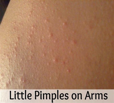 Little Pimples On Arms Remedies Corner Natural Skin Care Diy Diy