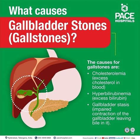 Understanding Bladder Stones Causes Symptoms And Prevention