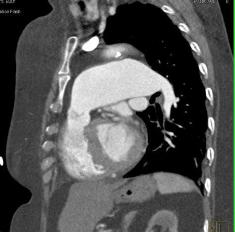 Dilated Main Pulmonary Artery Chest Case Studies Ctisus Ct Scanning