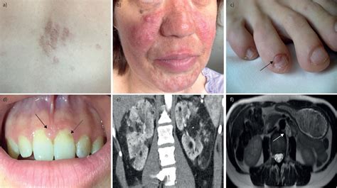 Tuberous Sclerosis Complex For The Pulmonologist European Respiratory