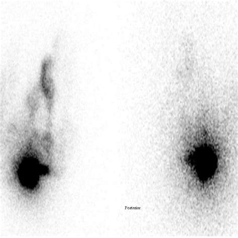 Planar Lymphoscintigraphy Of The Patient Anterior And Posterior
