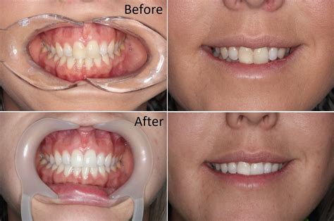 Teeth Whitening Cairns Before And After Dental On Martyn
