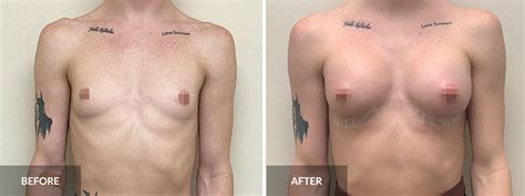 MTF Top Surgery Transgender Breast Augmentation South Florida