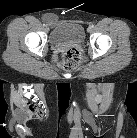 Hydrocele In The Canal Of Nuck Ct Appearance Of A Developmental Groin