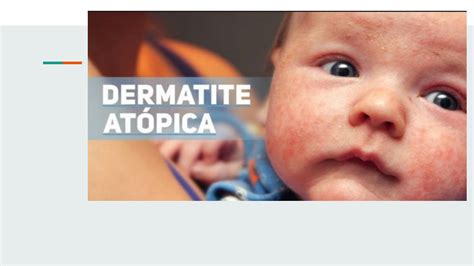 SOLUTION Dermatite At Pica Pediatria Resumo Studypool