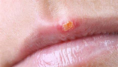 Cold Sores Are Highly Infectious Blisters That Develop On The Lips And Around The Mouth They
