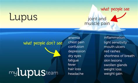 Lupus What People Dont See Infographic Mylupusteam